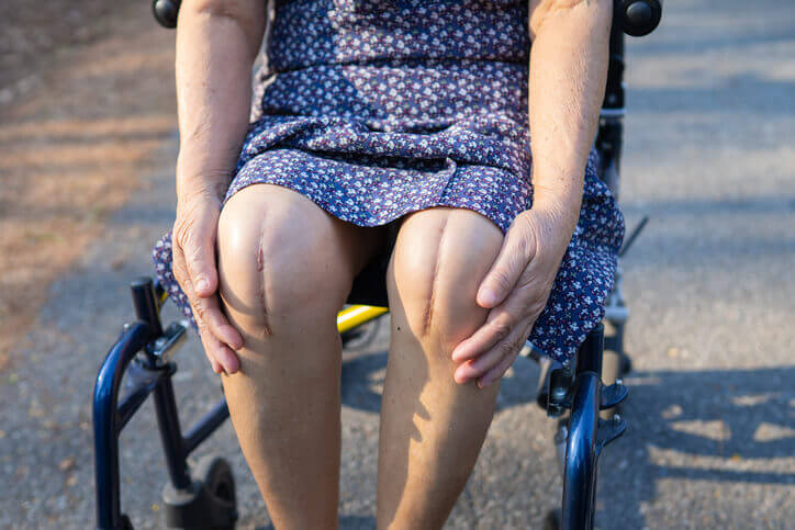 Elderly woman patient show her scars surgical total knee joint replacement