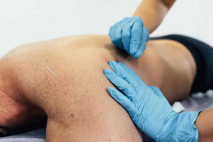 Using dry needling in physiotherapy — Pelvico Health Centre