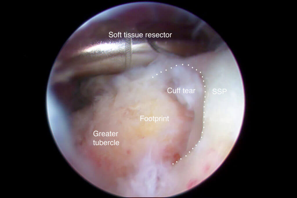 Arthroscopic view of rotator cuff tear of the shoulder