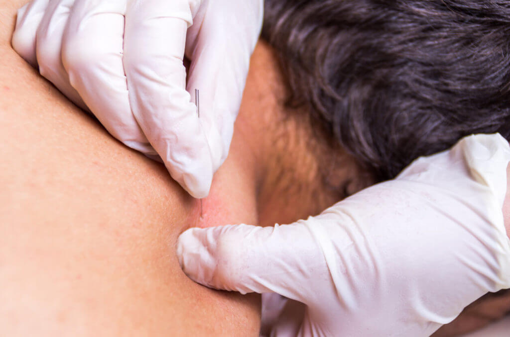 Dry needling for muscle pain in young man's back